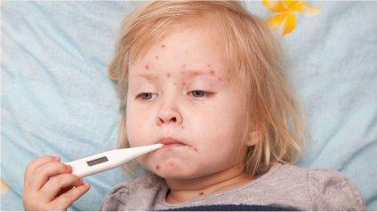 Спалах кору в Україні: що треба знати про хворобу і як захистити себе